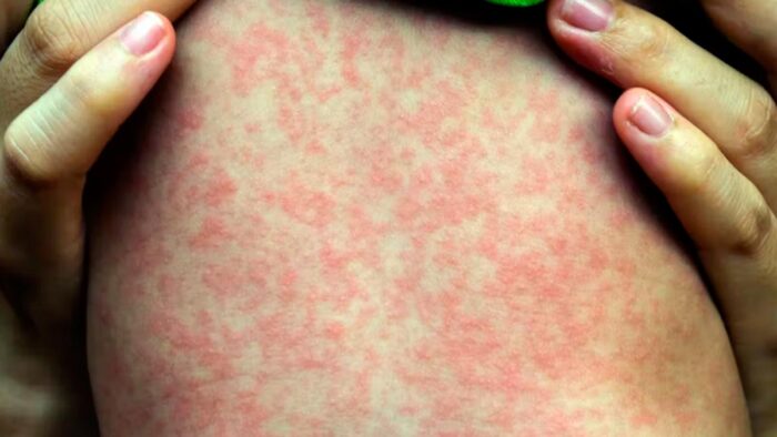 Brote de sarampión en el AMBA: confirman más de diez casos y refuerzan la campaña de vacunación